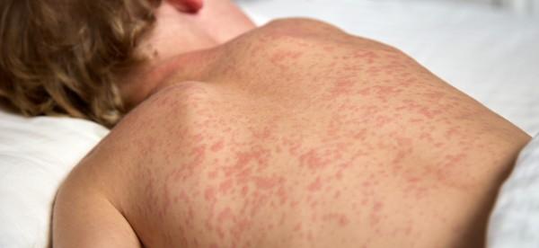 Governo do Acre decreta emergência em saúde pública por risco de disseminação do sarampo