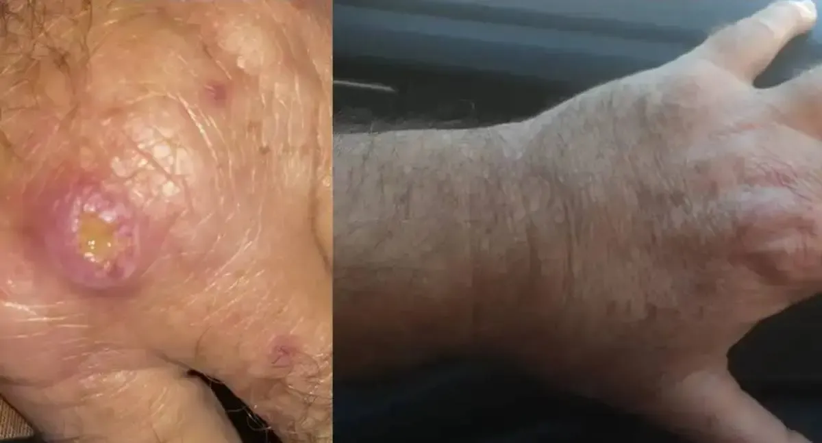 Especialistas alertam para a falta de informação sobre a leishmaniose