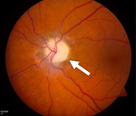 Metanol em bebidas adulteradas pode causar cegueira e até morte, alertam especialistas